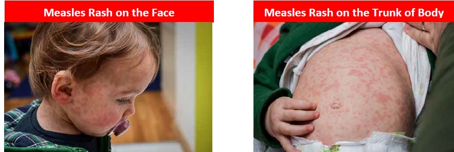 Image of measles rash on face and trunk of body