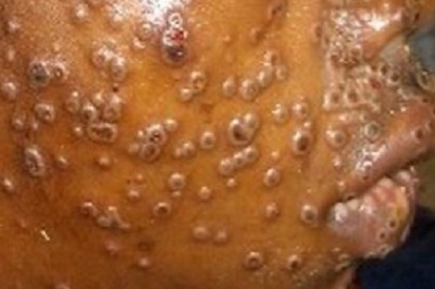 monkeypox lesions on face