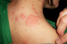 Image of bed bug bites on the neck and shoulder